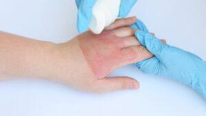 What To Know In Treating Burns Of Any Degree